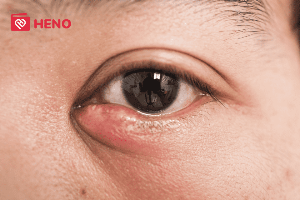 Nguyên nhân gây ra chắp lẹo mắt và cách điều trị hiệu quả nhất